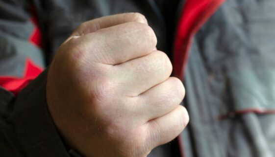 Verurteilung wegen schwerer Körperverletzung aufgrund Faustschlags auf Auge